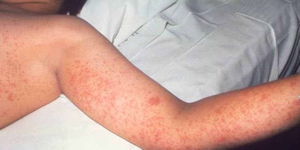 Third measles case confirmed in Georgia, linked to unvaccinated international visitor